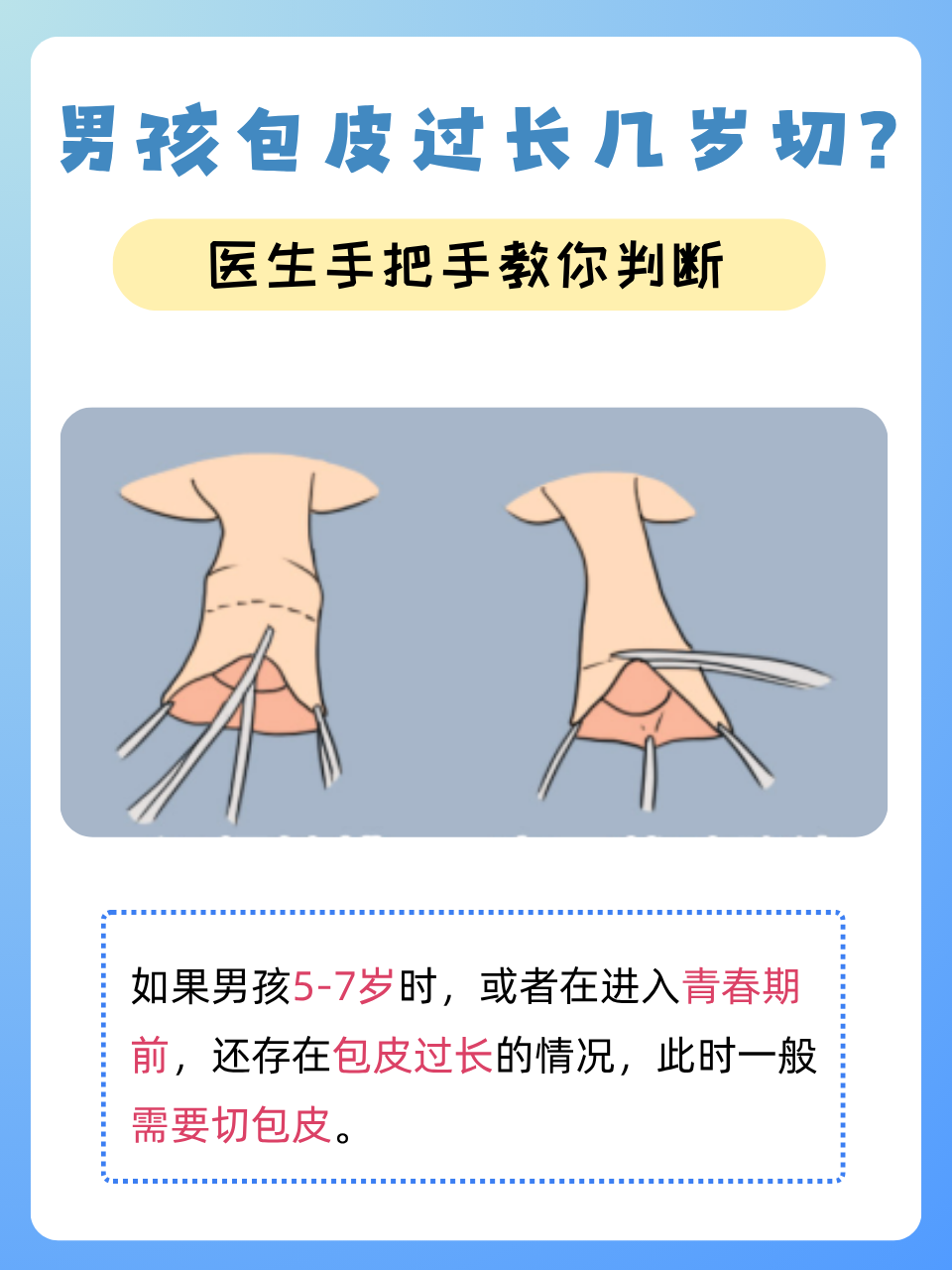 男孩包皮过长几岁切?