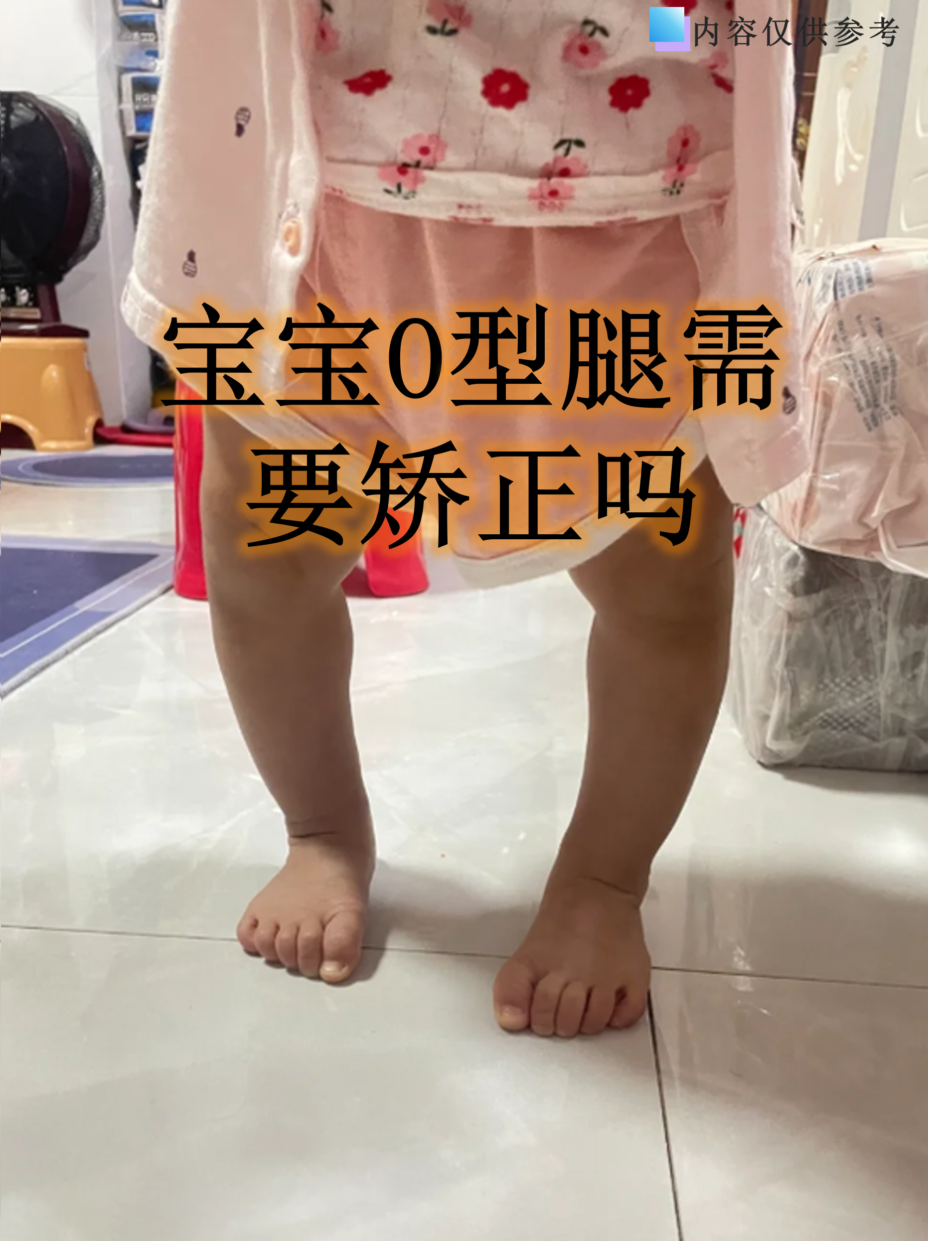 宝宝o型腿需要矫正吗