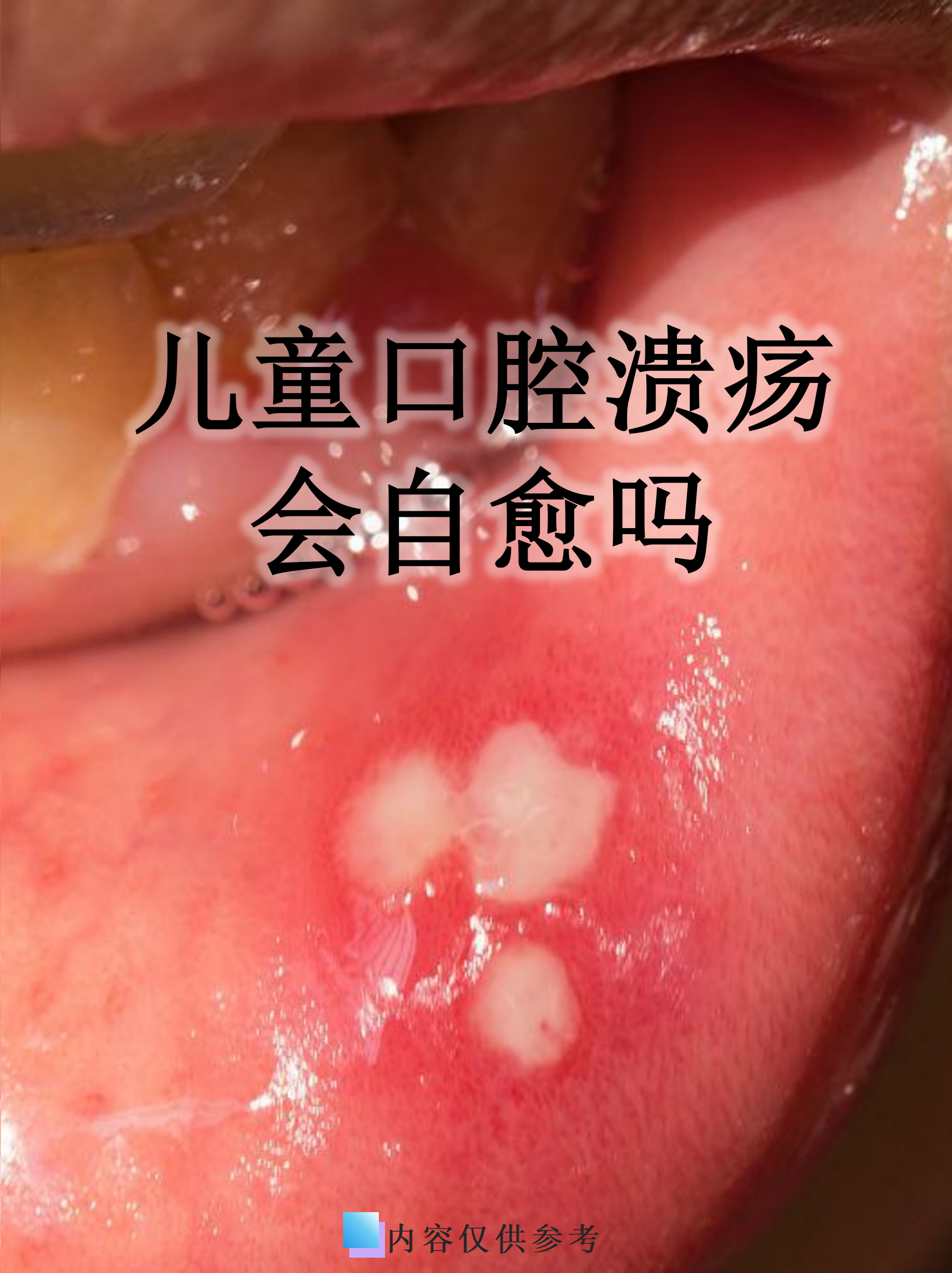  什么病毒会引起持续发烧口腔溃疡发作(什么病毒会引起发烧呕吐)