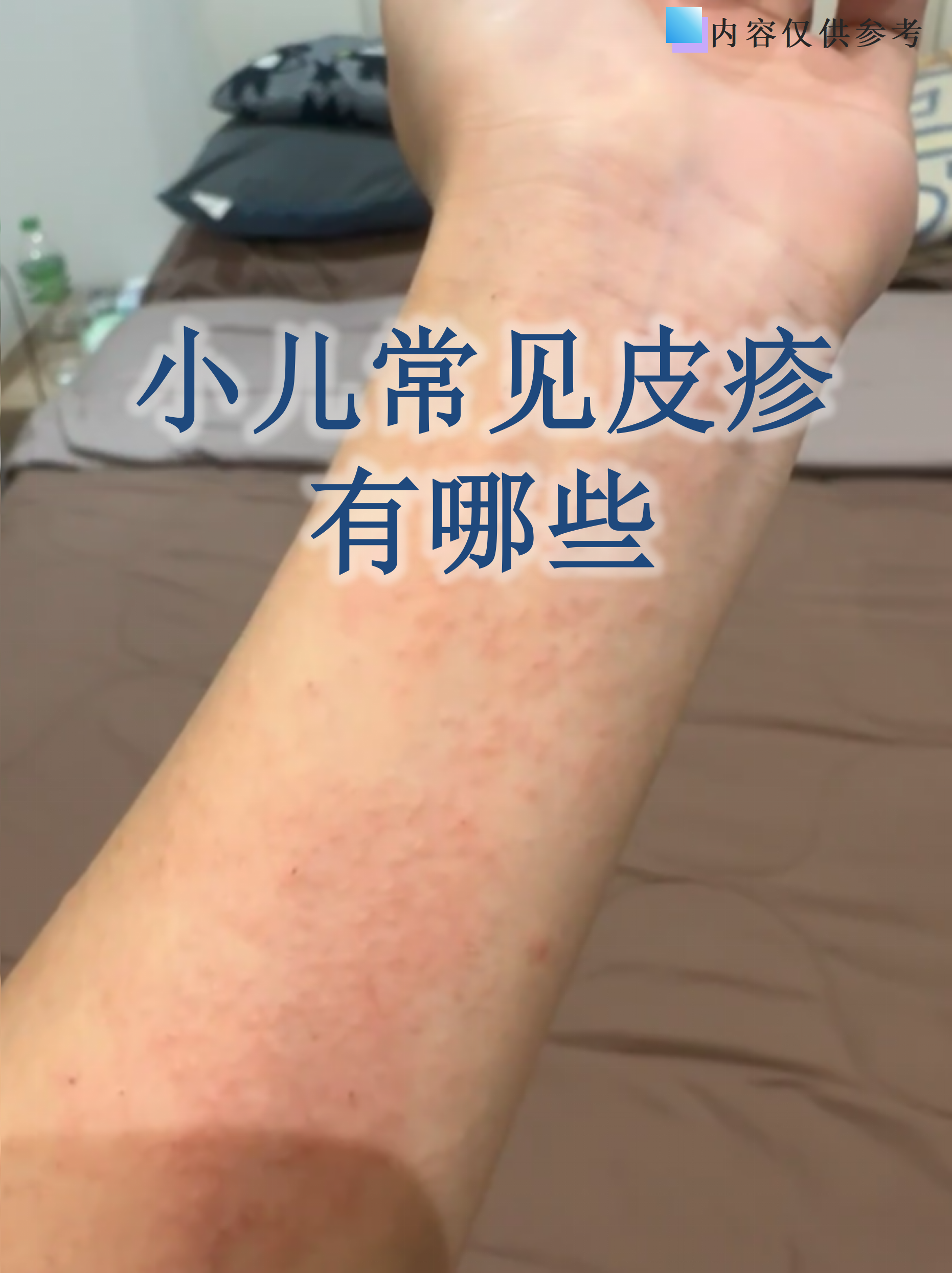 孩子皮肤突然出现红疹,很多家长会手足无措