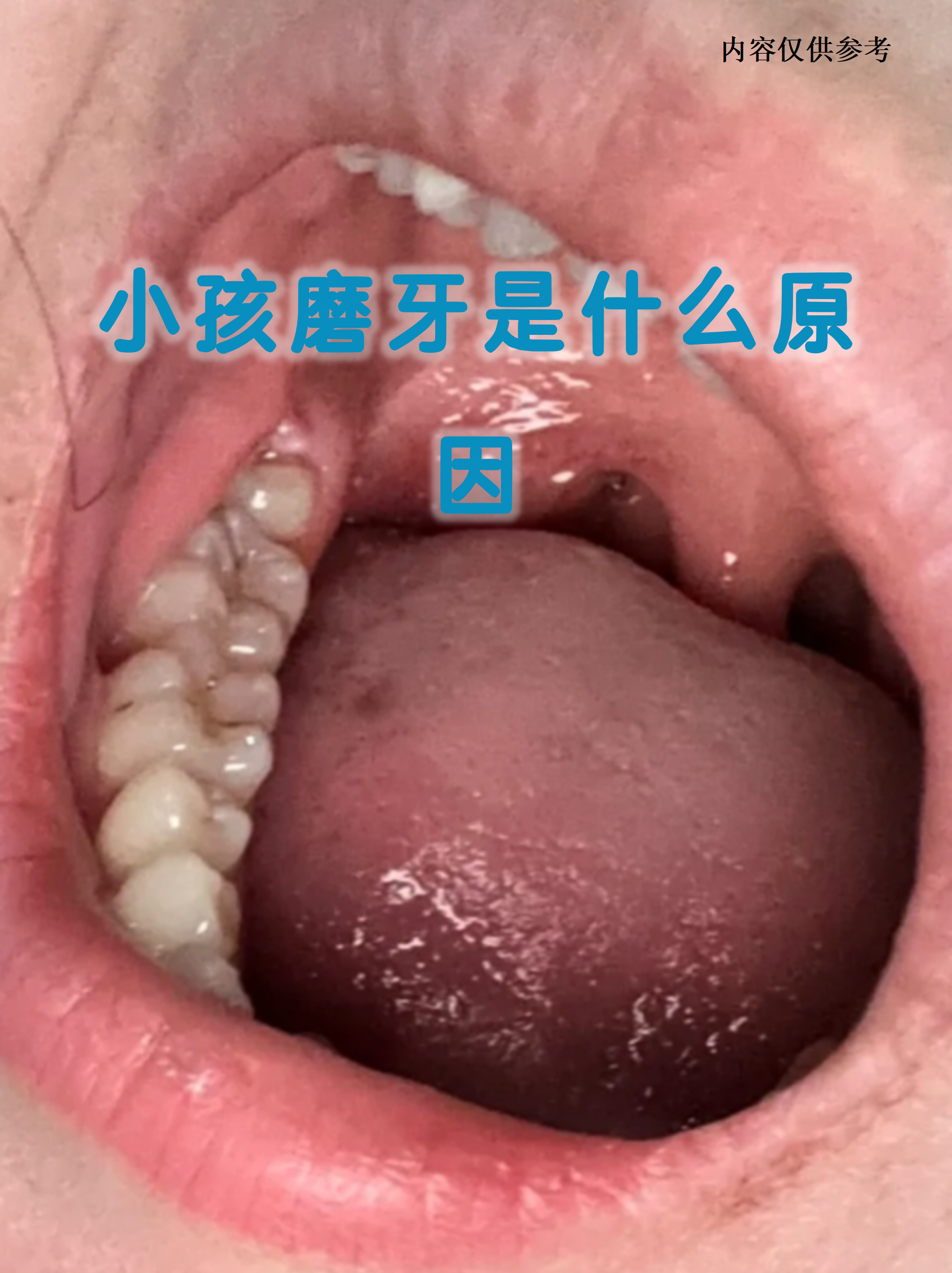 小孩夜间磨牙是许多家长头疼的问题,背后可能