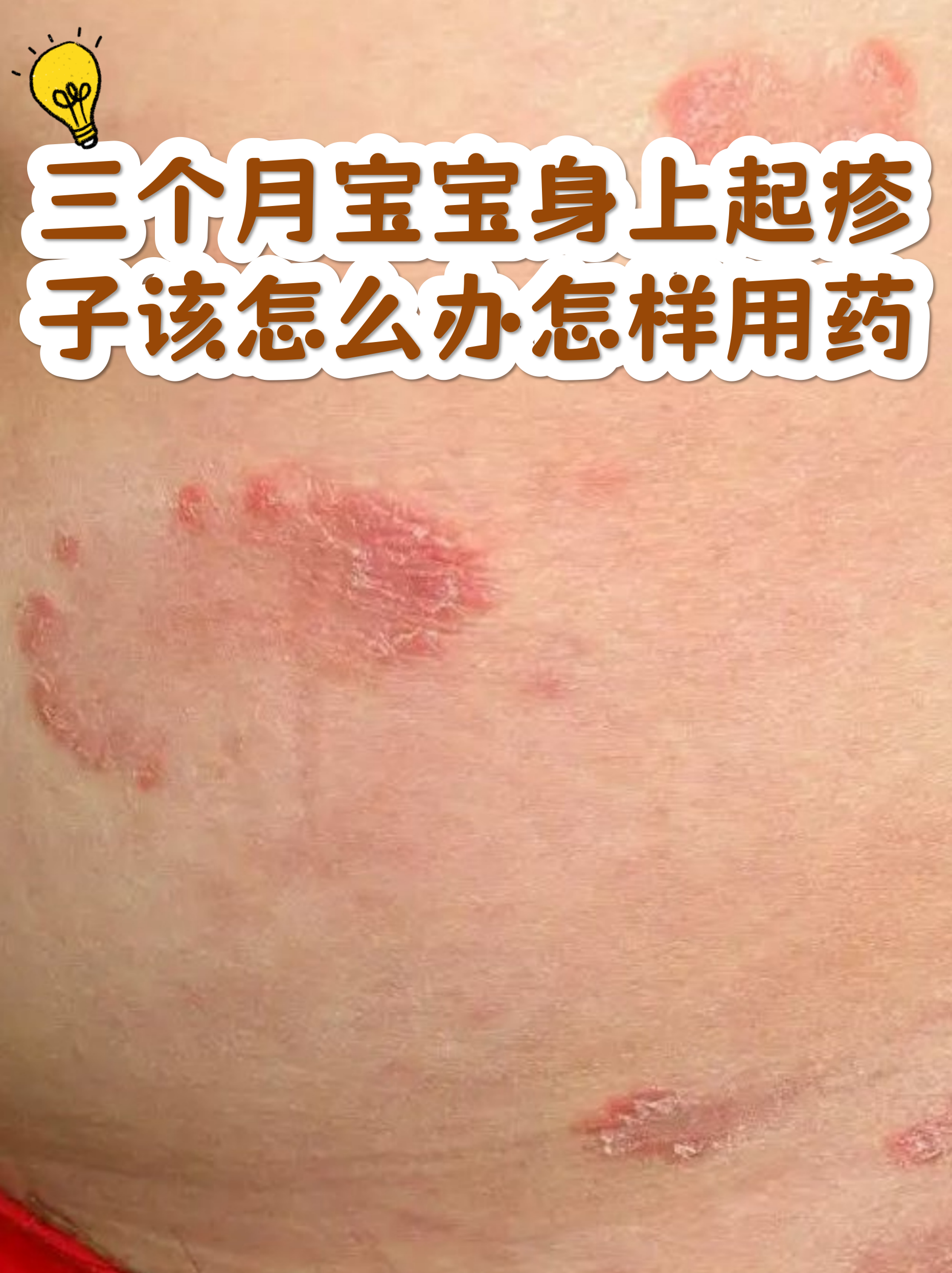 三个月宝宝身上起疹子该怎么办怎样用药