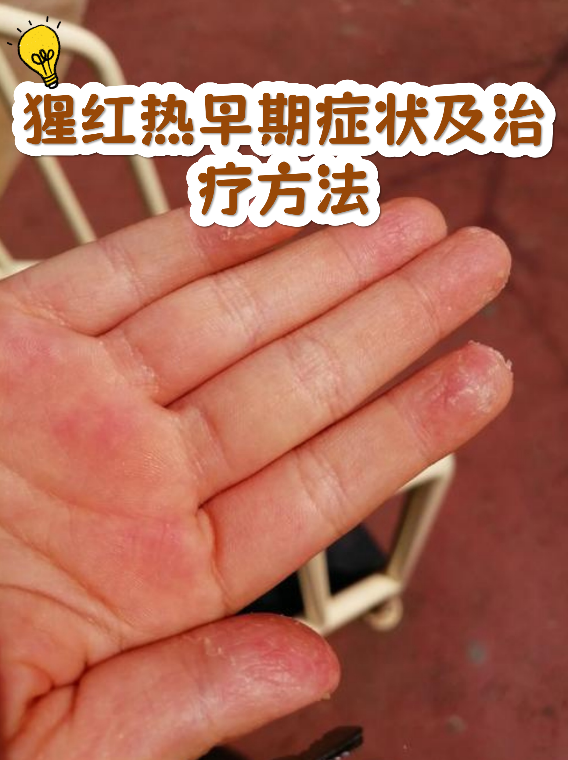 猩红热早期症状及治疗方法