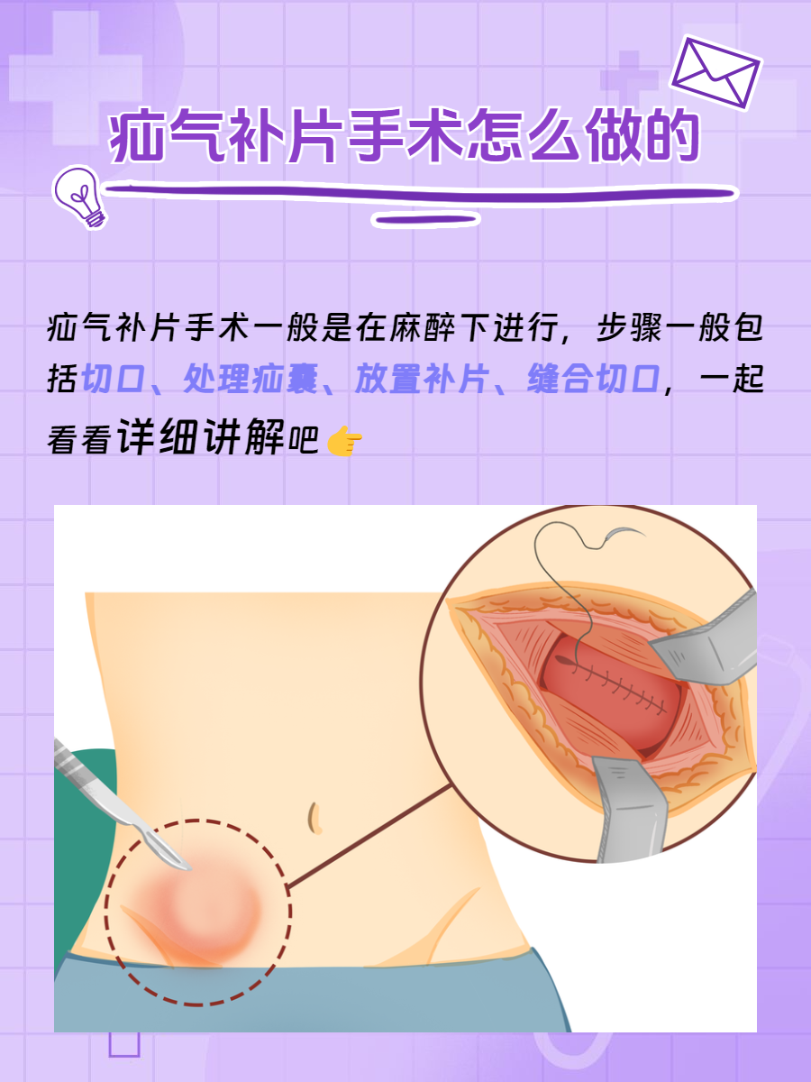 疝气无张力修补术图解图片