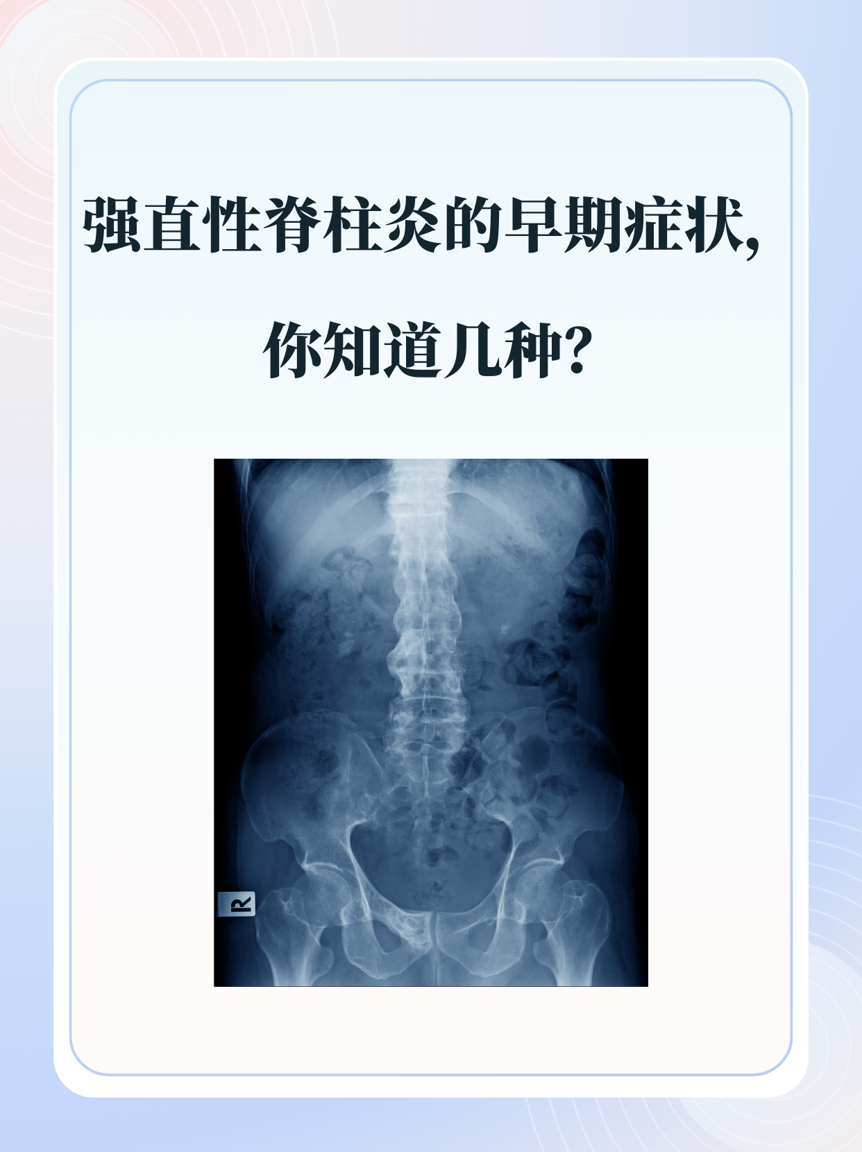 强直性脊柱炎的早期症状,你知道几种?