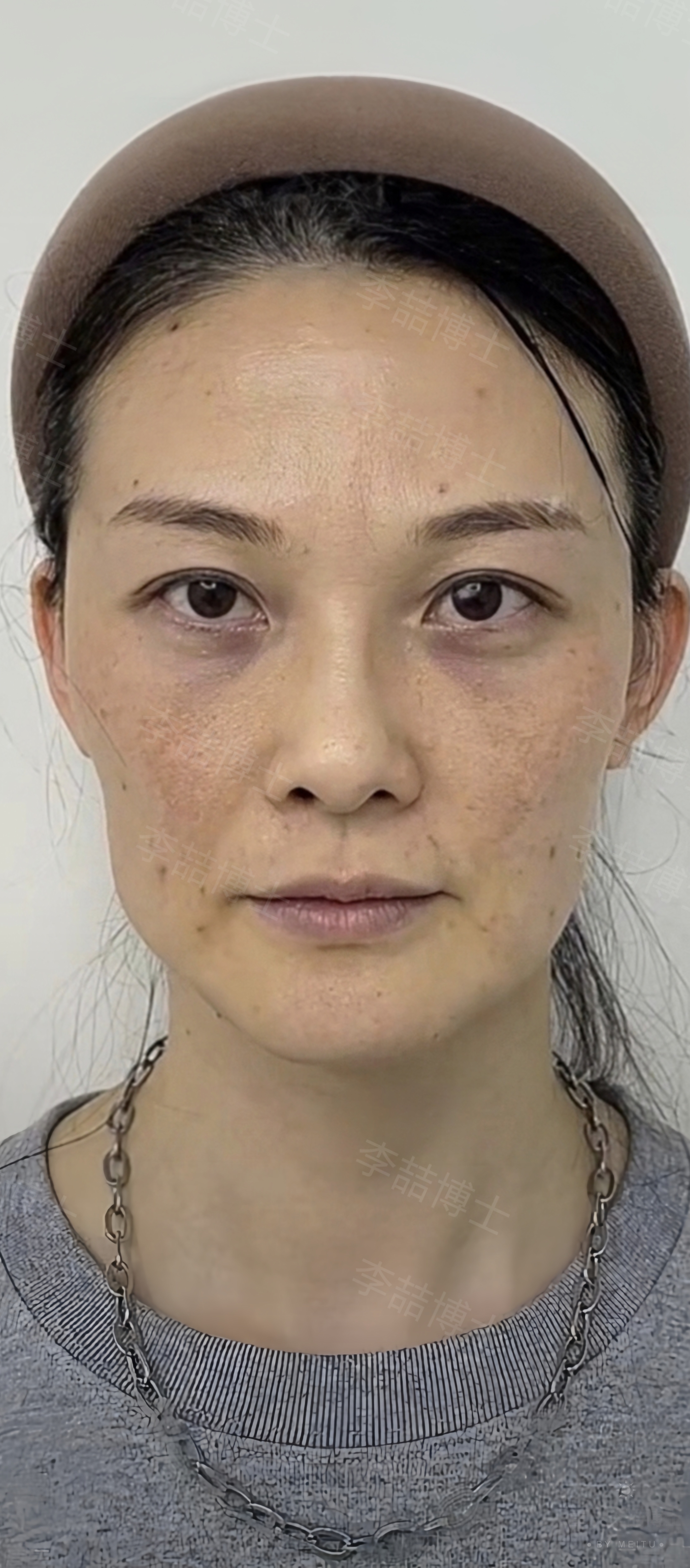 眼周筋膜提升手术效果怎么样?