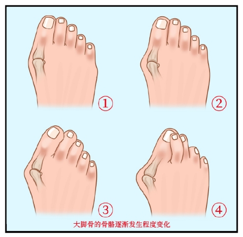 拇外翻早期多数人都不太在意,觉着除了难看一点也不