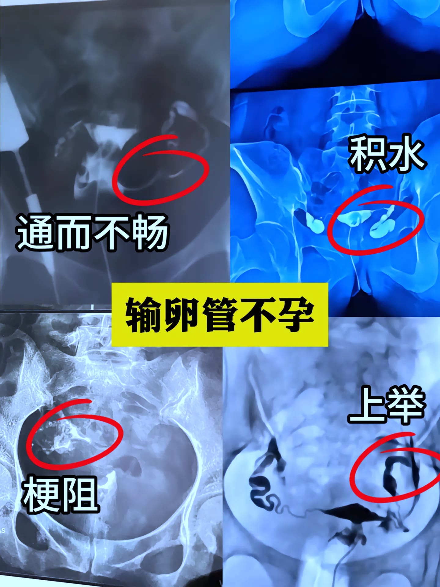 输卵管上举造影图图片