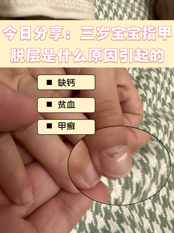 今日分享:三岁宝宝指甲脱层是什么原因引起的  [鼓掌]大家有没有遇到