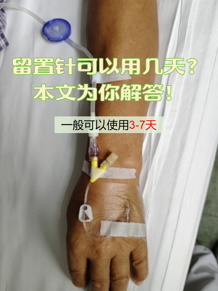 留置针通常是血管内留置针,包括了导管,楔形物和导管座,可以