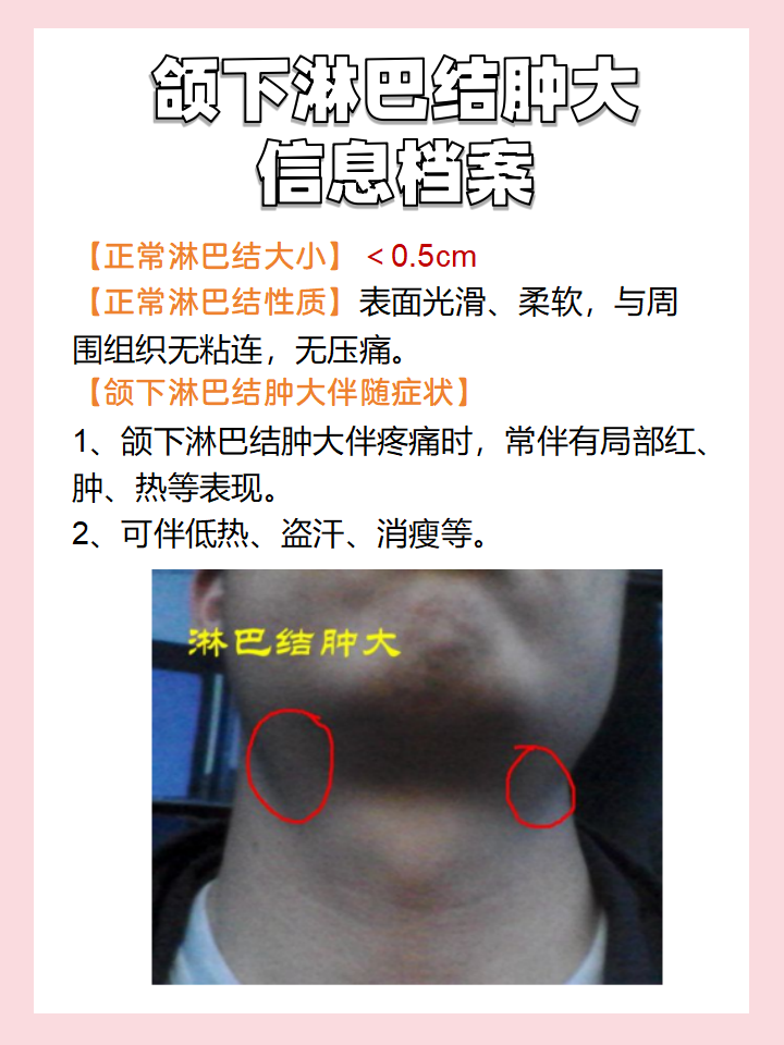 一文了解|颌下淋巴结肿大2厘米正常吗?