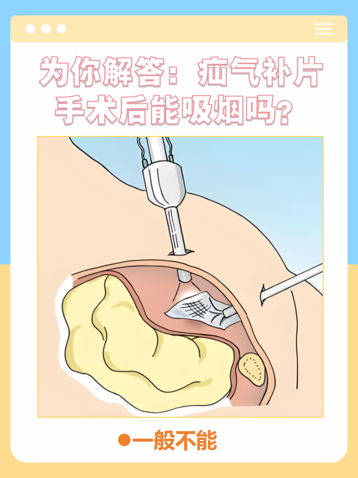 疝气无张力修补术图解图片