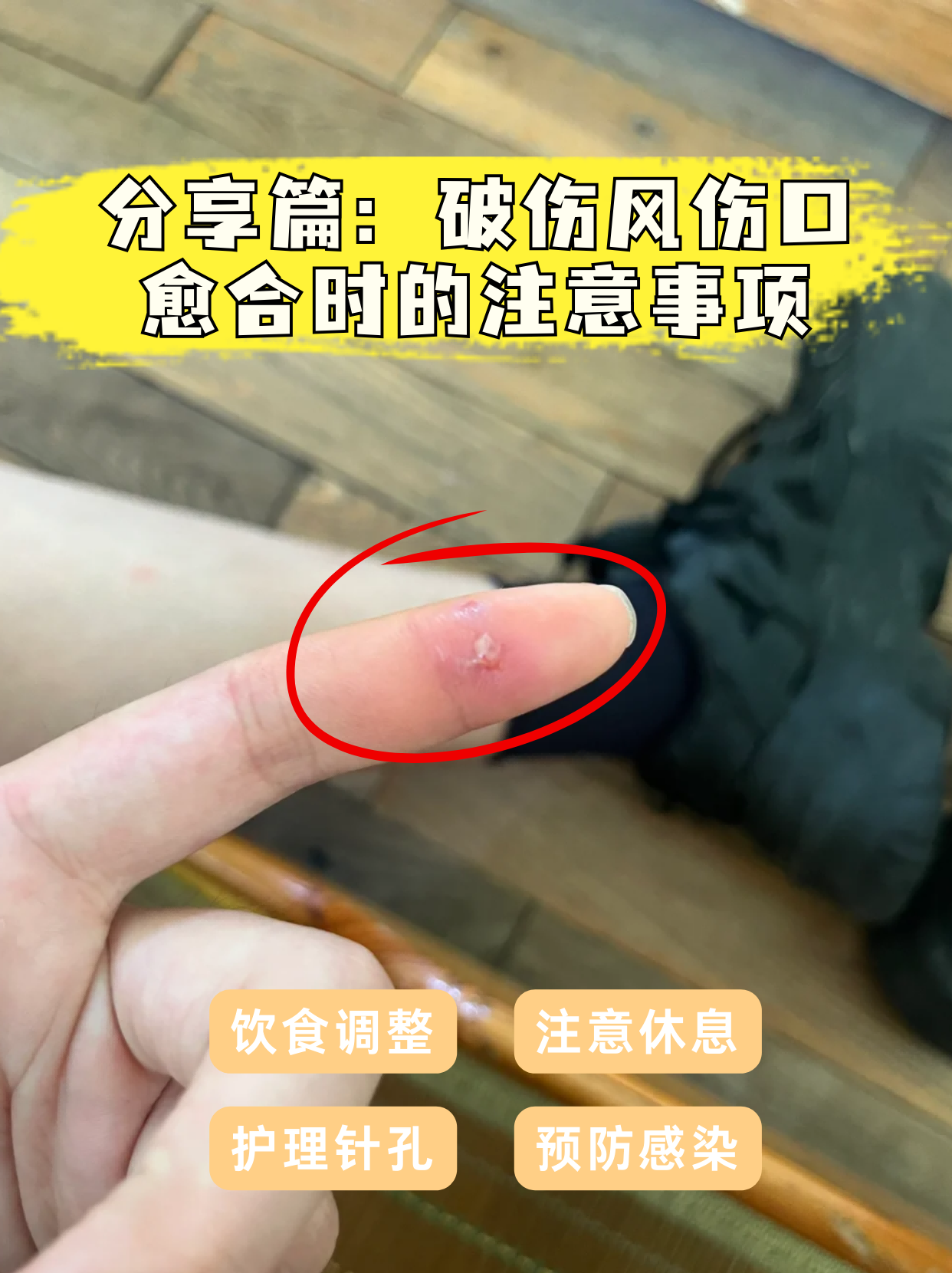 的伤口图片破伤风图片破伤风伤口症状图片破伤风症状破伤风的伤口特点