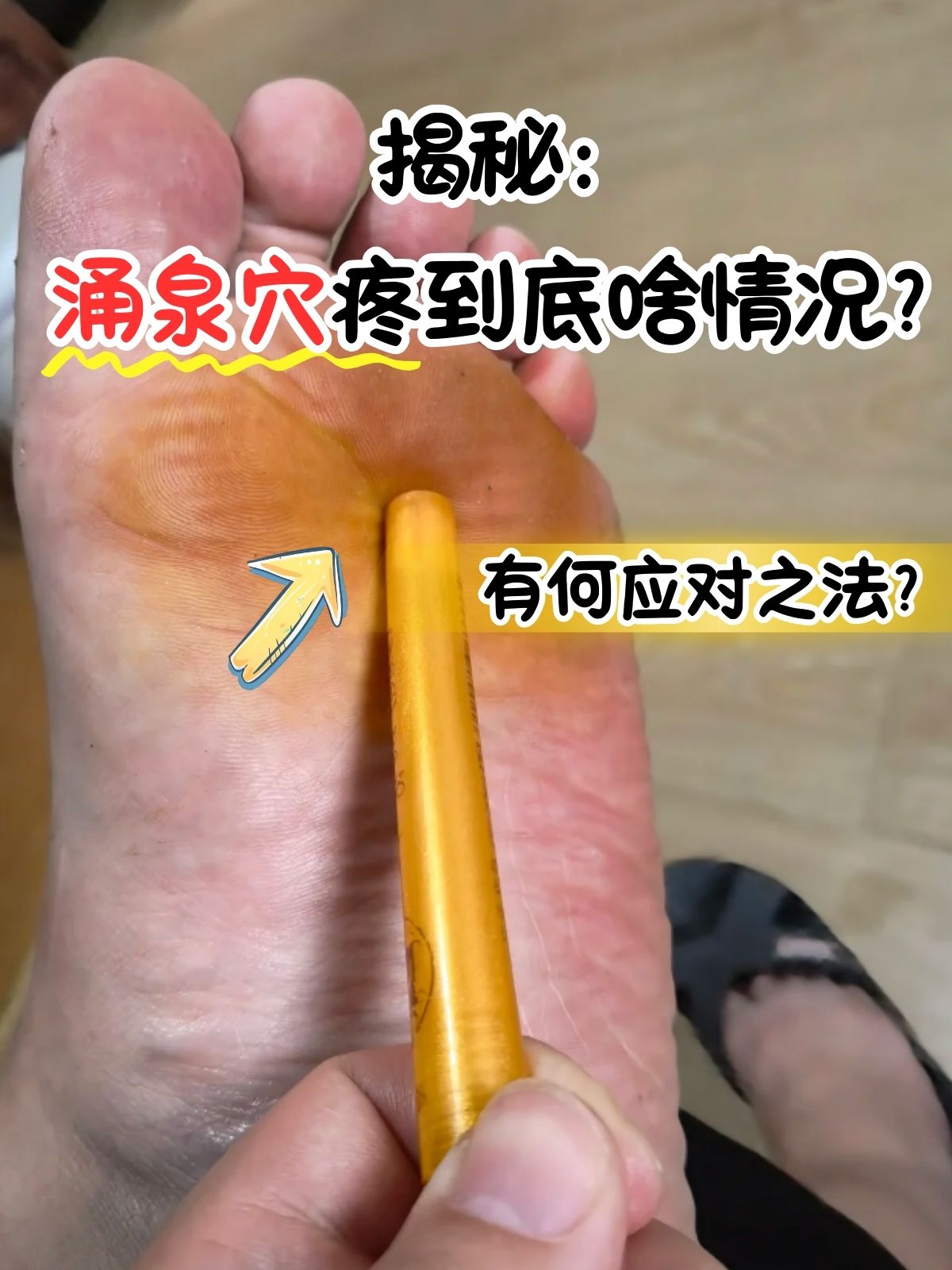 涌泉穴位于足底掌侧前面,是足少阴肾经上的重要穴位,具有开窍苏厥