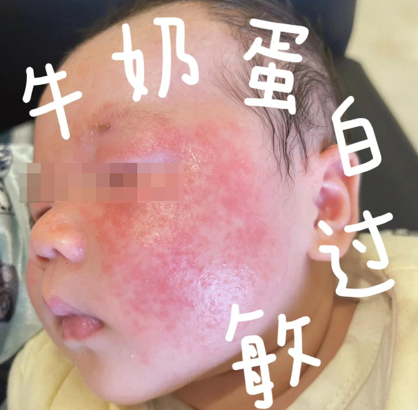 牛奶蛋白过敏是婴幼儿常见的食物过敏之一,很多家长发现宝宝喝完奶粉