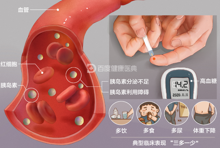 其中2型糖尿病患者占95%以上,病因包括胰岛素抵抗,胰岛素进行性分泌不