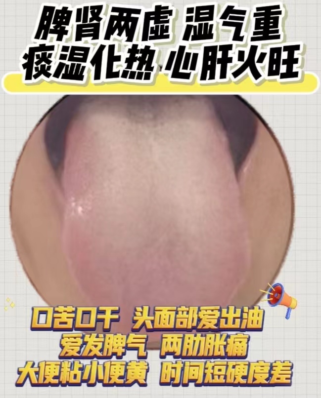 一,舌头后面略窄,提示肾气不足,舌面水滑,舌苔白,往舌根方向苔白