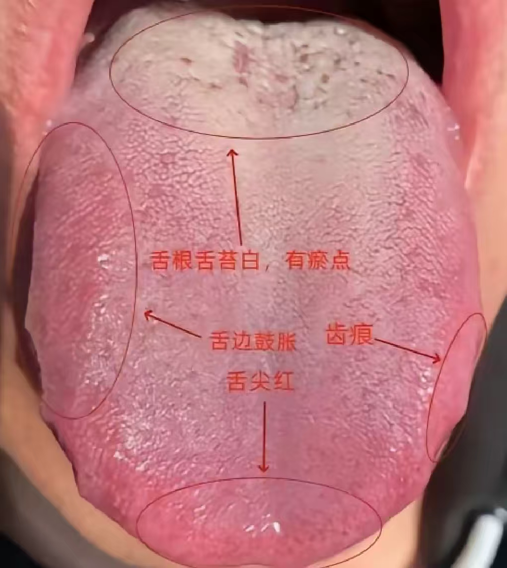 1.舌边和舌尖鼓胀发红,提示心肝火