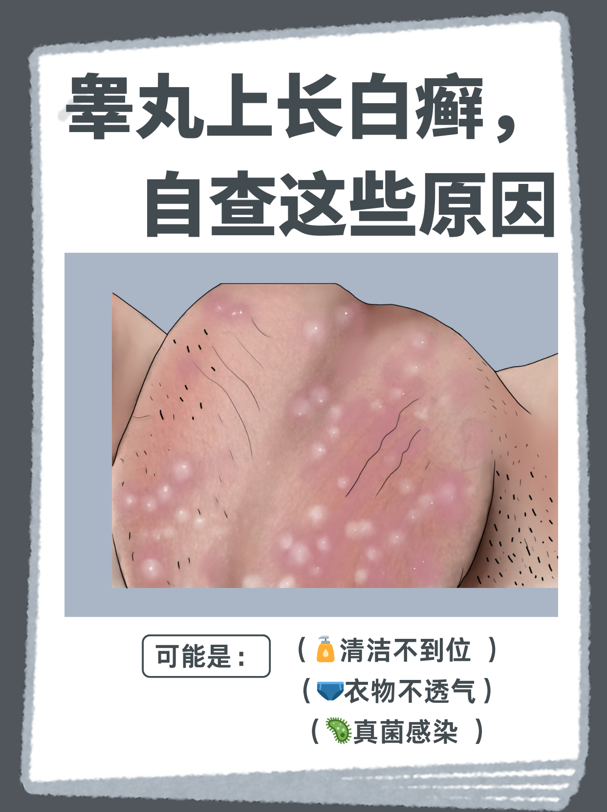 睾丸上长白癣,自查这些原因