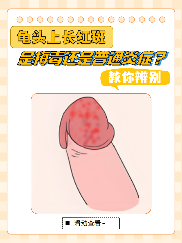 教你辨别  私密部位出现异常红斑,龟头上的红斑究竟是普通炎症作祟