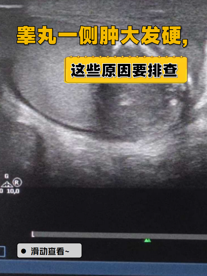 睾丸一侧肿大发硬,这些原因要排查