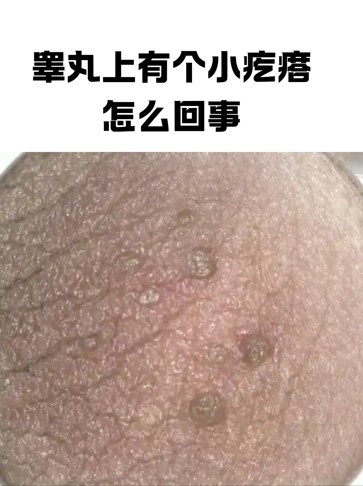 睾丸上有个小疙瘩怎么回事