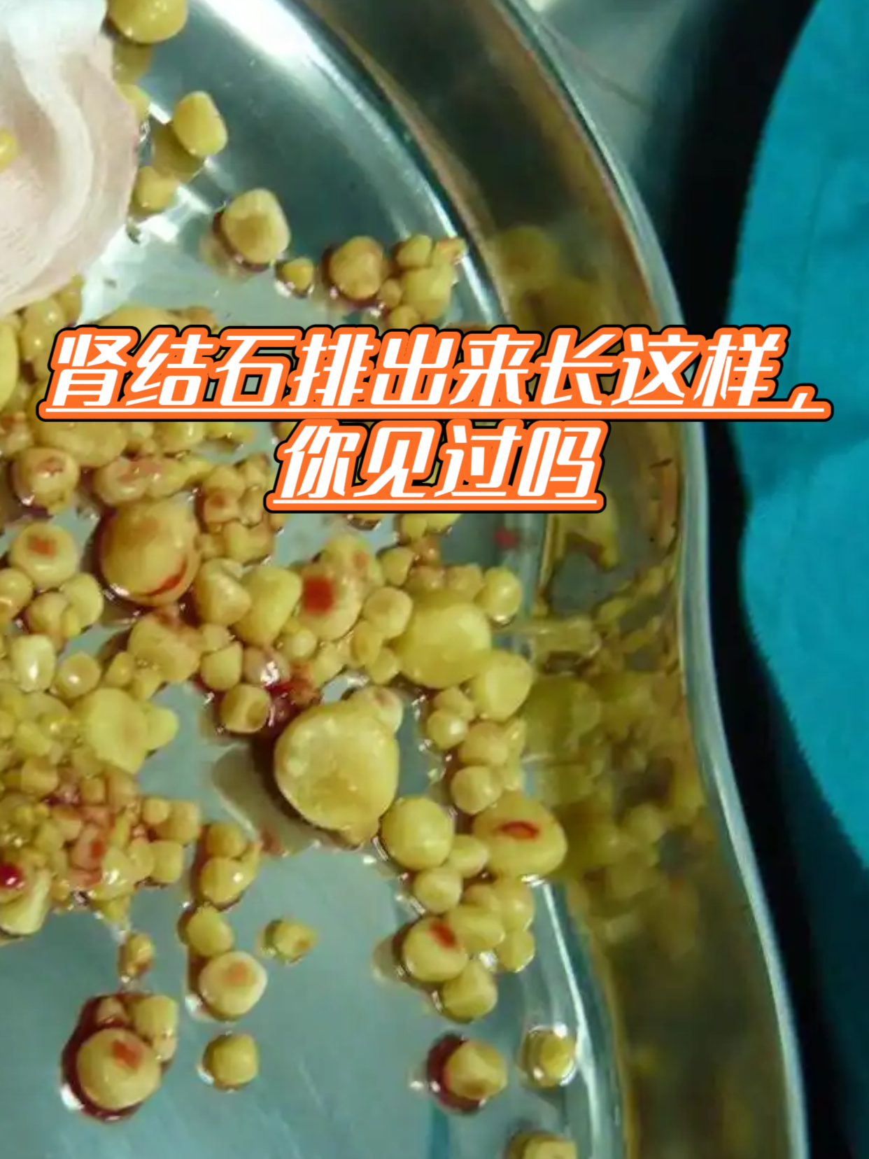肾结石排出来长这样,你见过吗