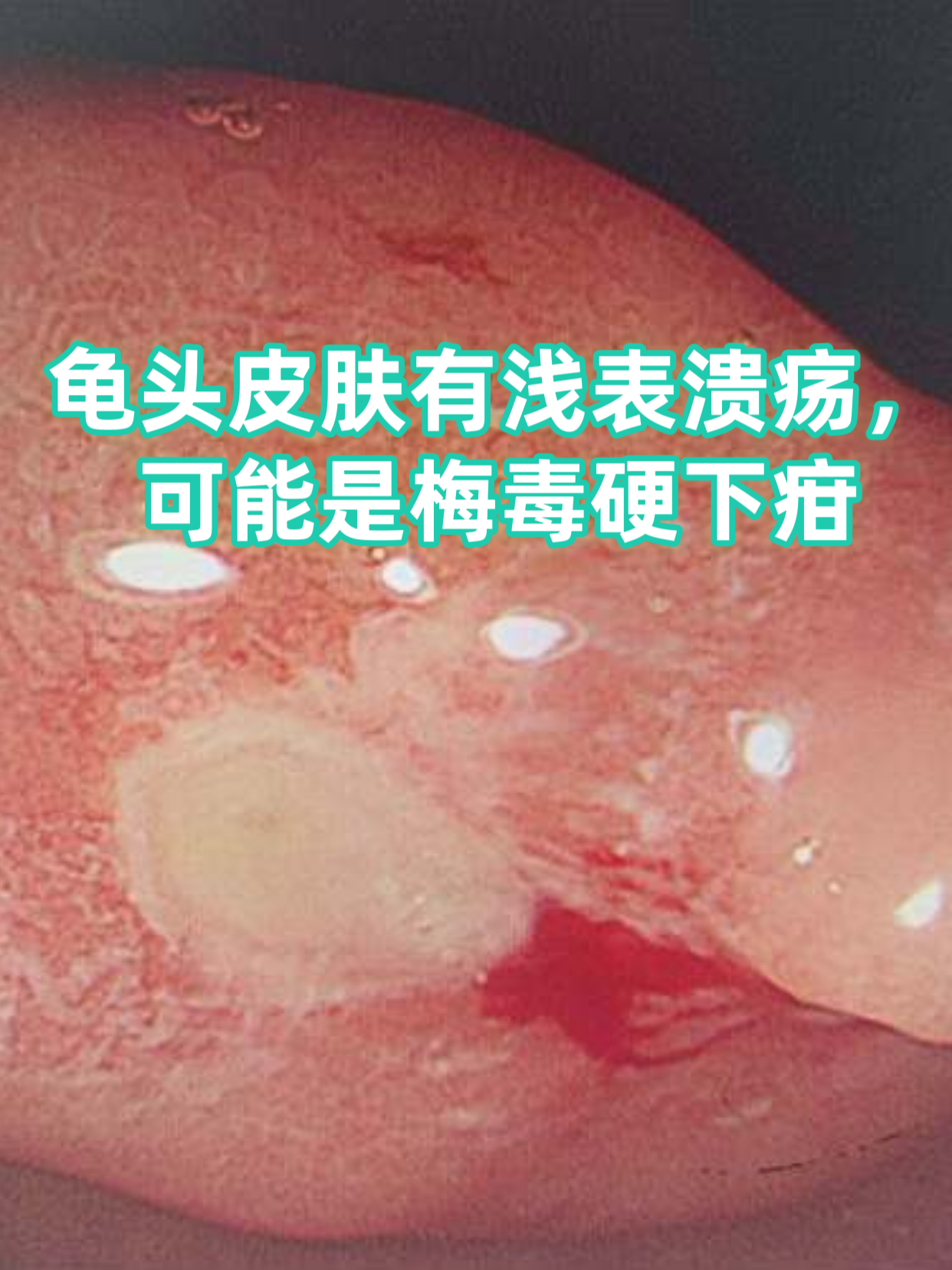 龟头出现浅表溃疡确实需要警惕,夏季高发的性传播疾病中,梅毒硬下疳