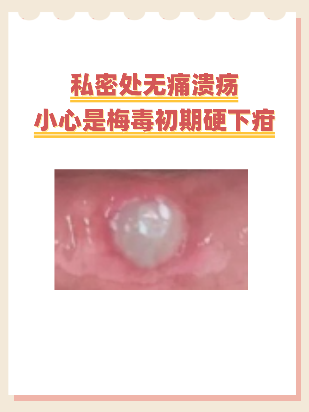 私密处无痛溃疡,小心是梅毒初期硬下疳