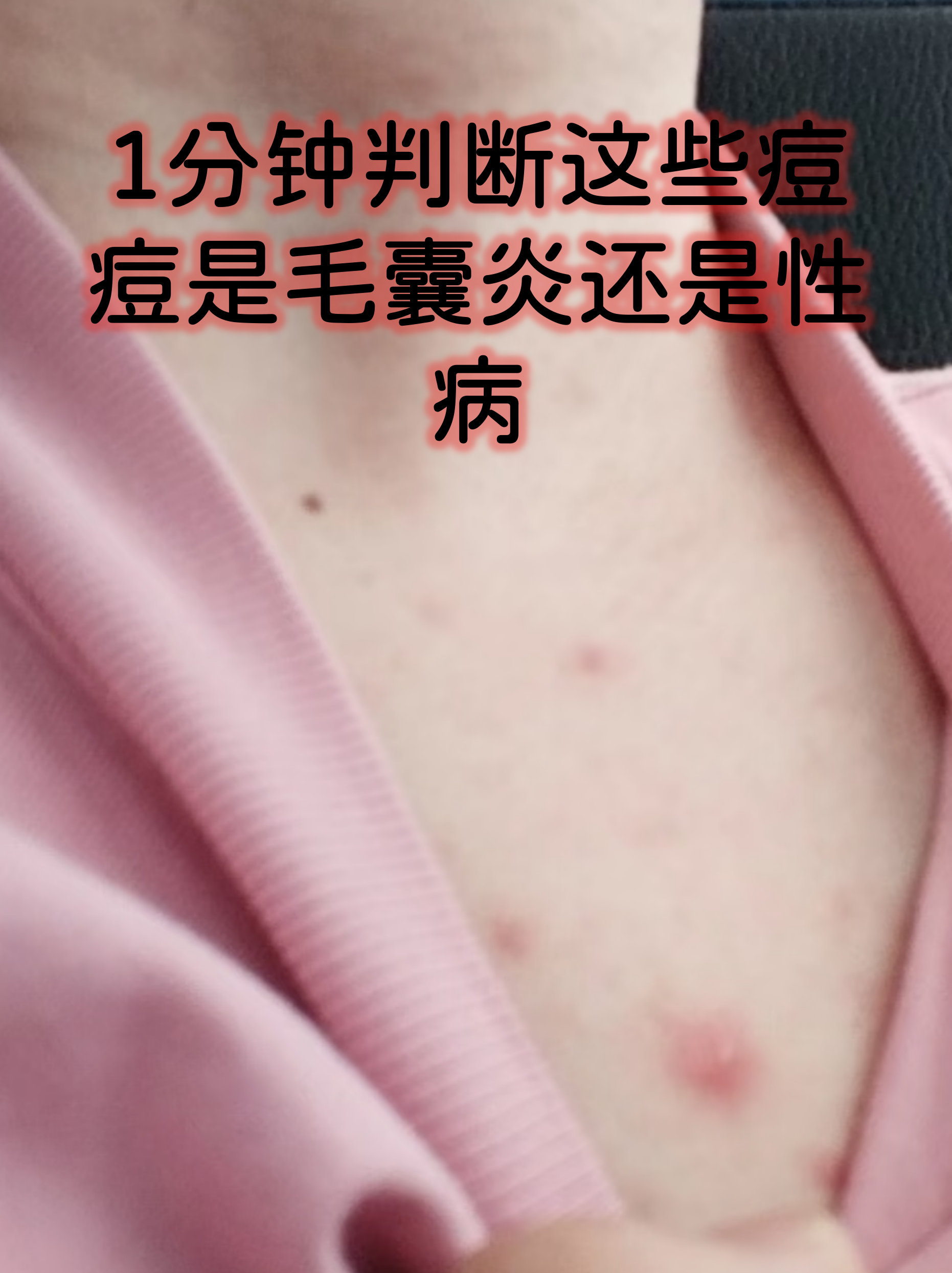 1分钟判断这些痘痘是毛囊炎还是性病
