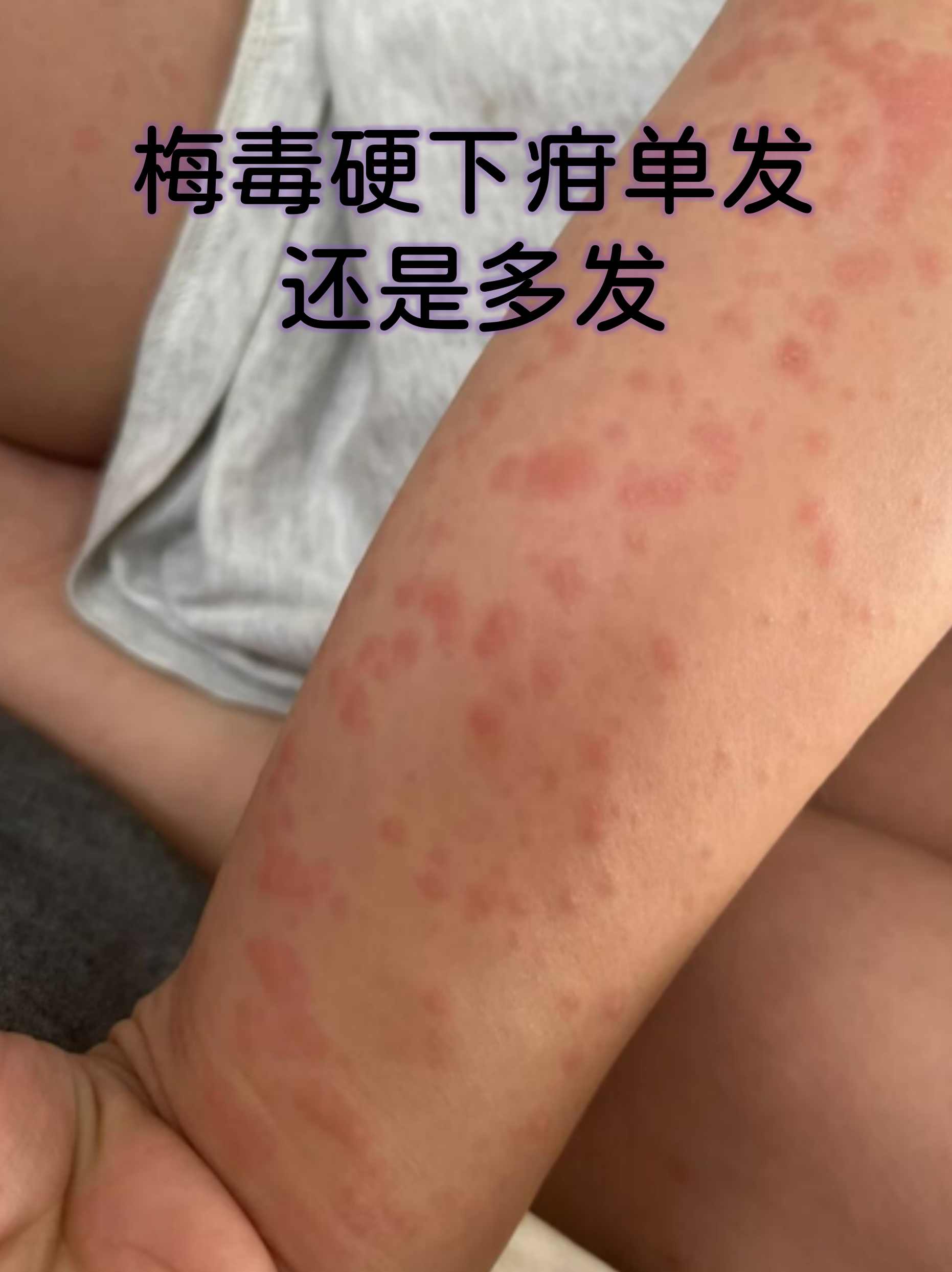 梅毒硬下疳单发还是多发