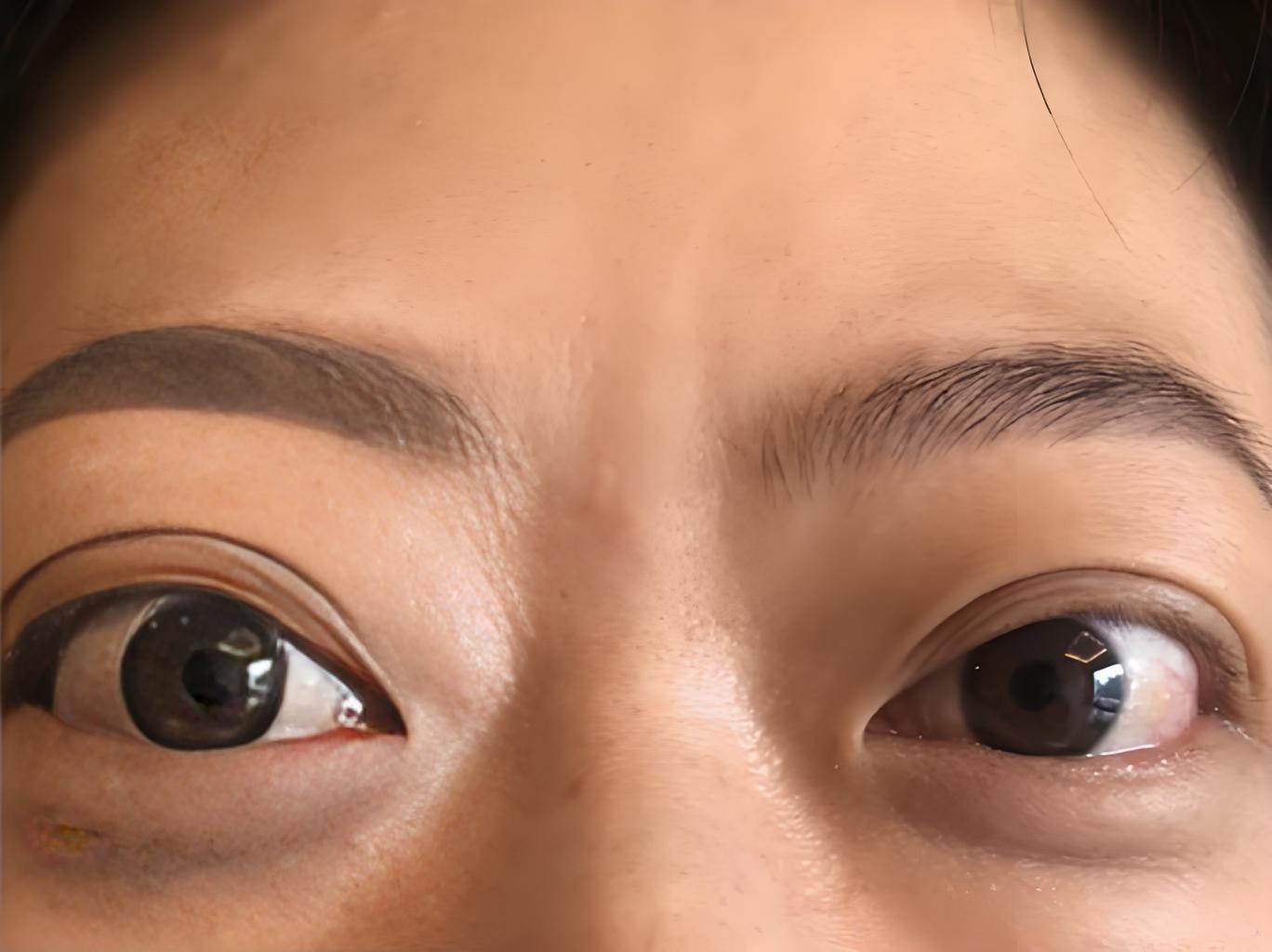 甲亢突眼忌口清单!再吃这4类食物,眼睛更难缩回去!