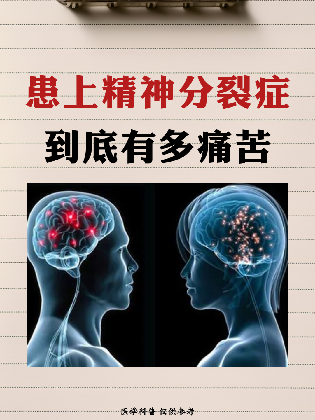 精神分列症的主要表现是(精神分列症形成原因?表现)