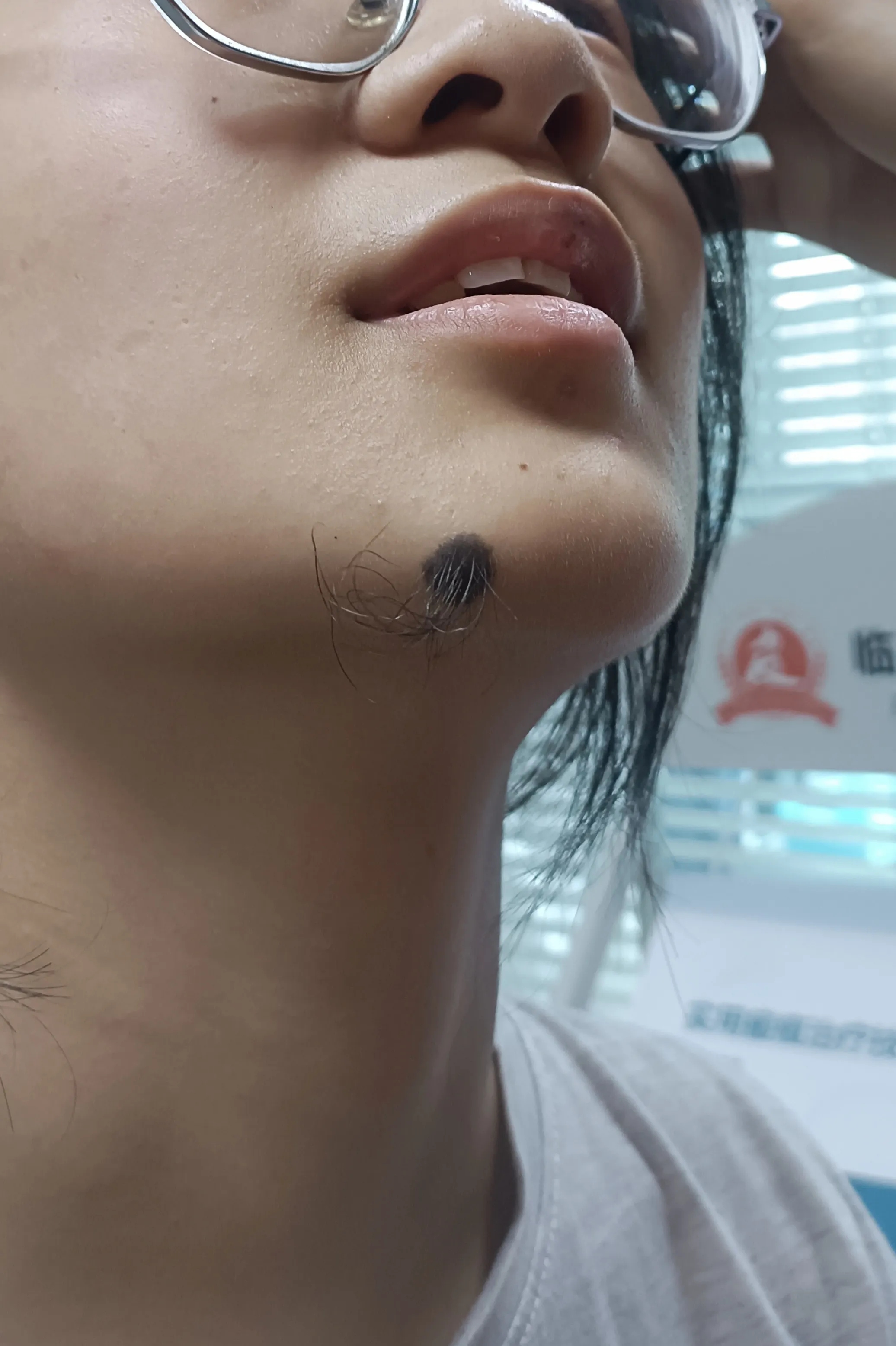 我现在很为难,不知道该不该听她的,把那颗痣去掉呢?