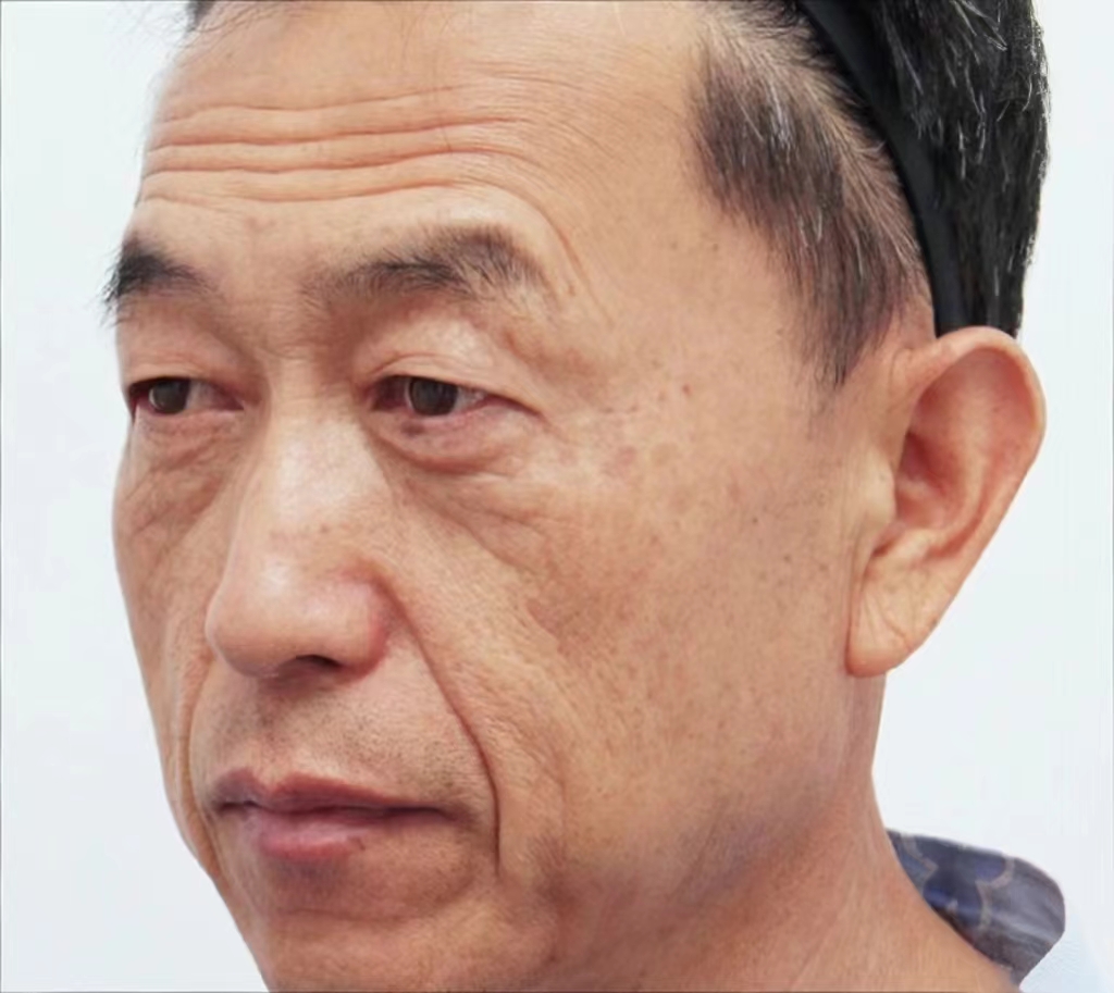 图片男人老头法令纹男人做拉皮手术的图片大全男性法令纹大拉皮男士