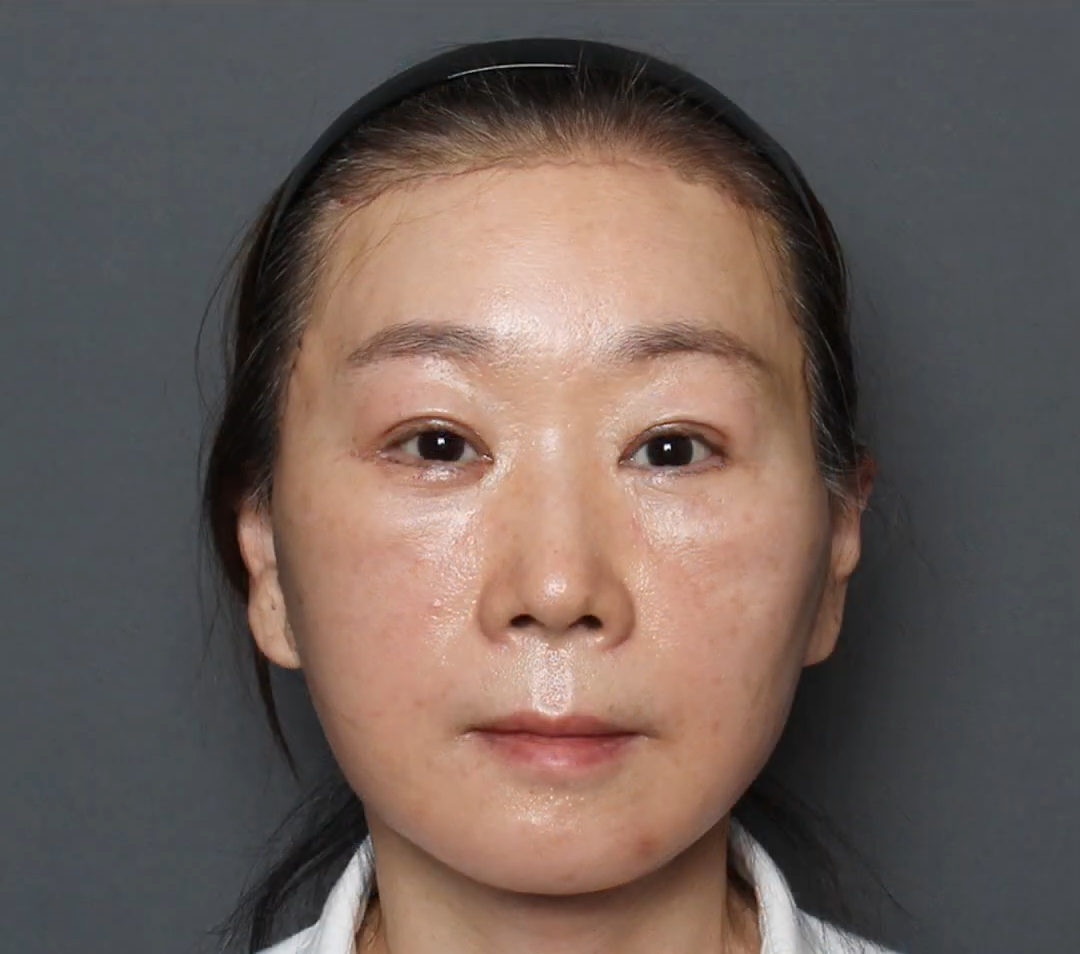 一位 54 岁的求美者亲身经历,术后8天,17天,45天的惊人变化!