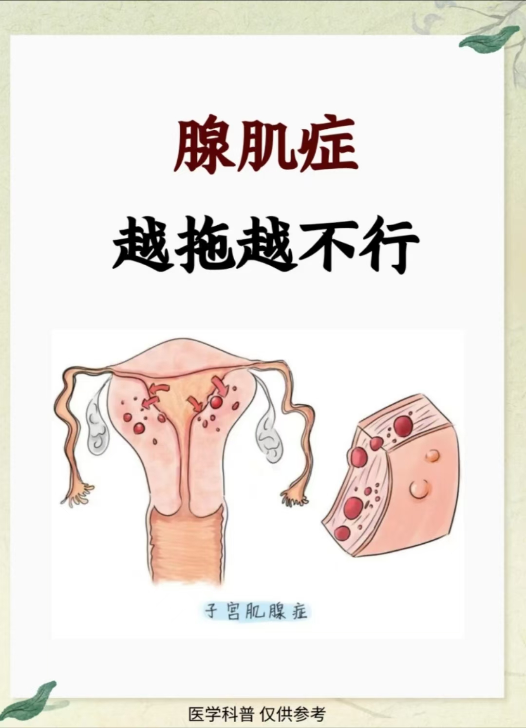 子宫腺肌症是怎么得的图片