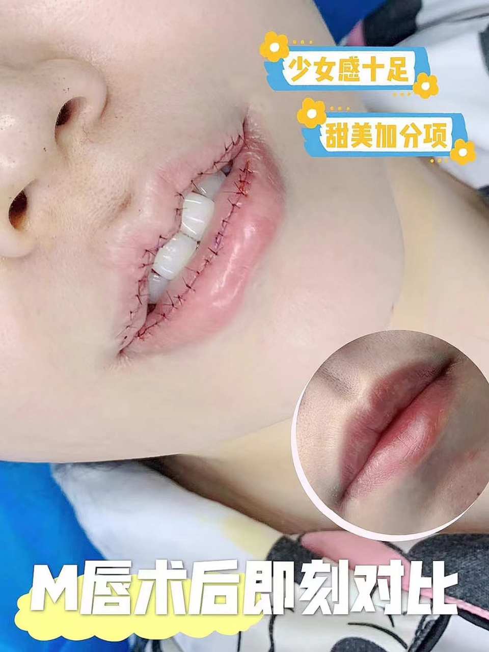 唇综合术后对比🆚 甜美自然得m唇,性感可爱笑起来真好看💕 #唇部