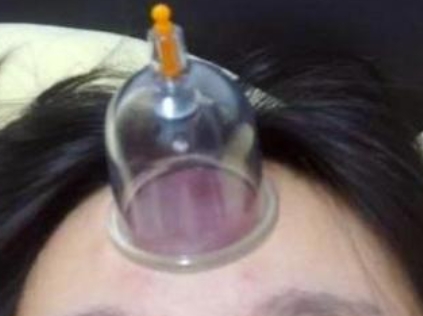 我还是第一次见到在额头拔罐得