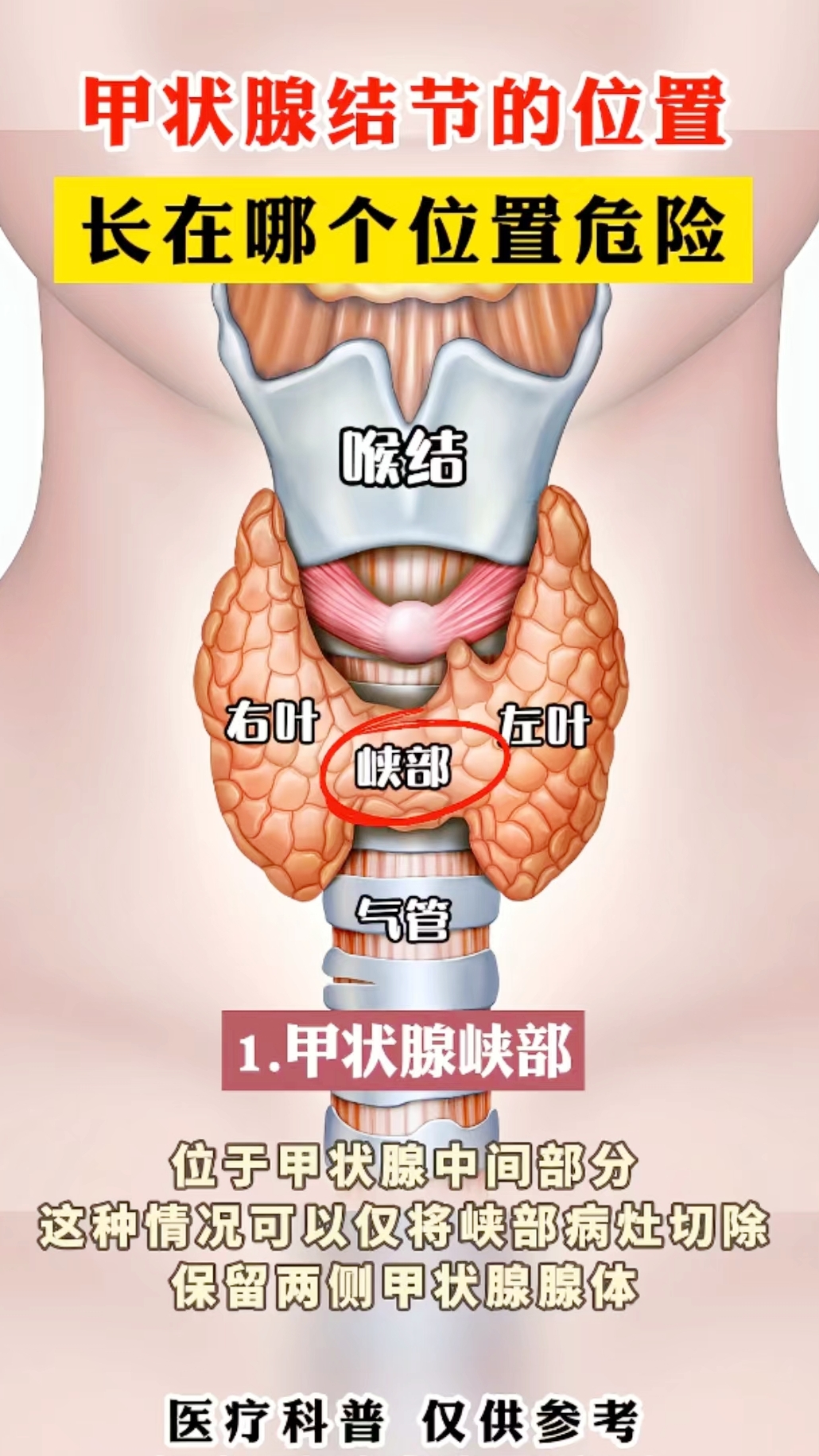 甲状腺结节的位置不同,后果不一样.#甲状腺结节
