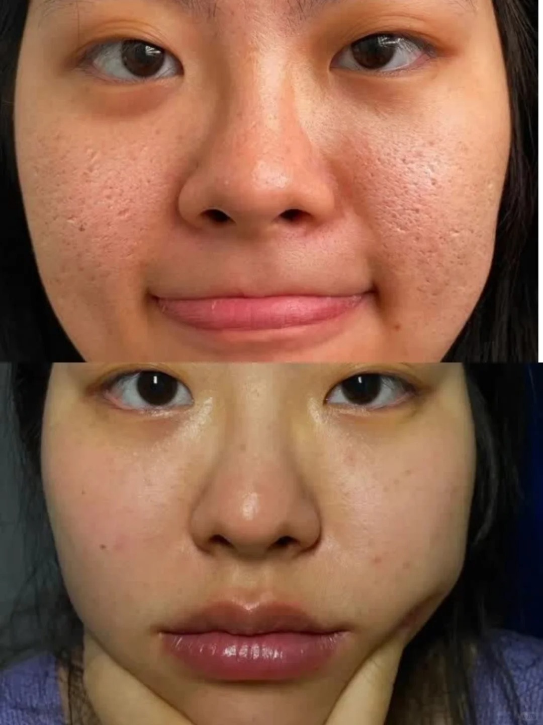 之前出去我从来不敢和别人对视 因为脸上的痘坑让我自卑