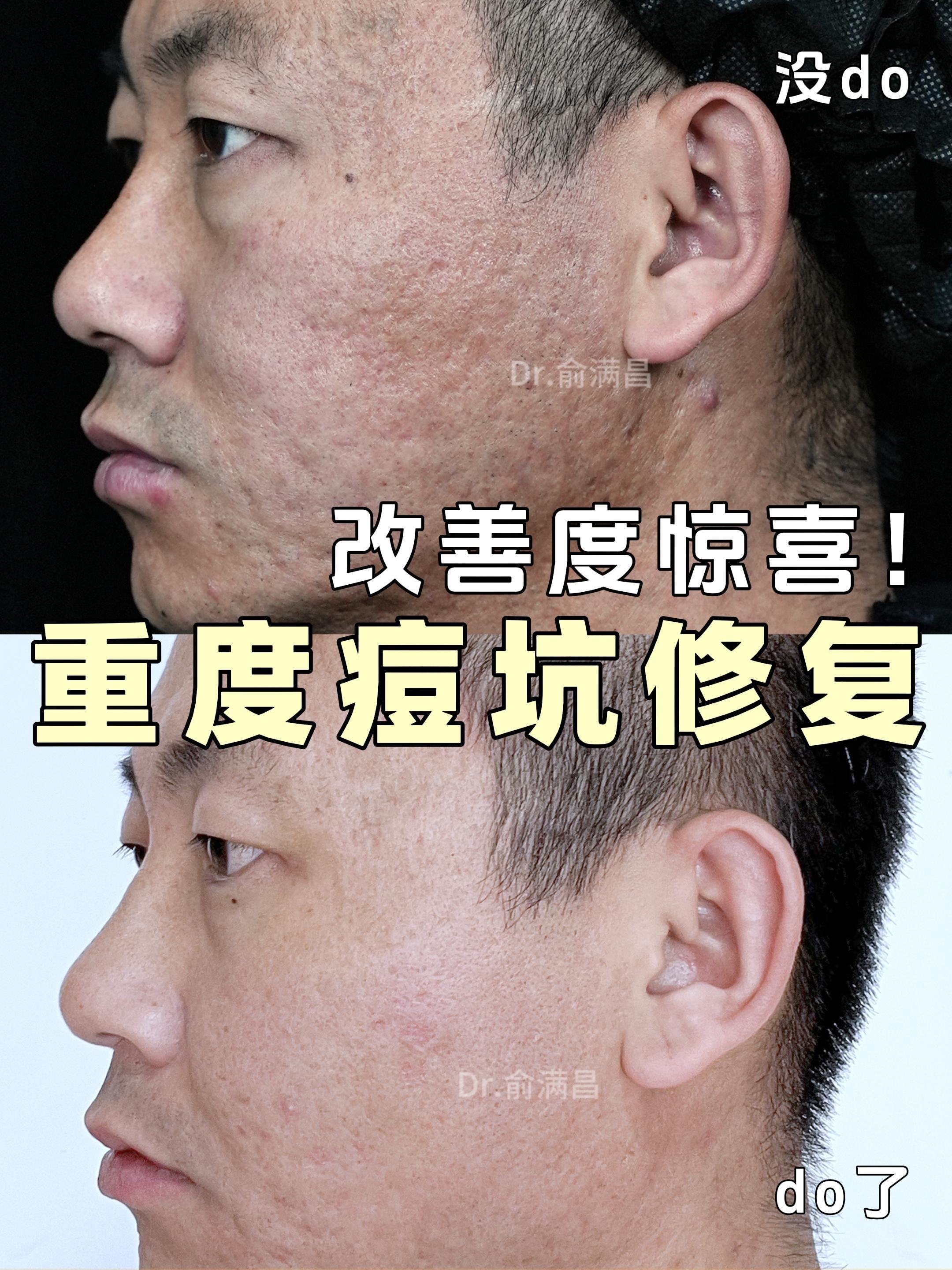 30 + 单身男的痘坑自述两次治疗坑坑脸终于见好转