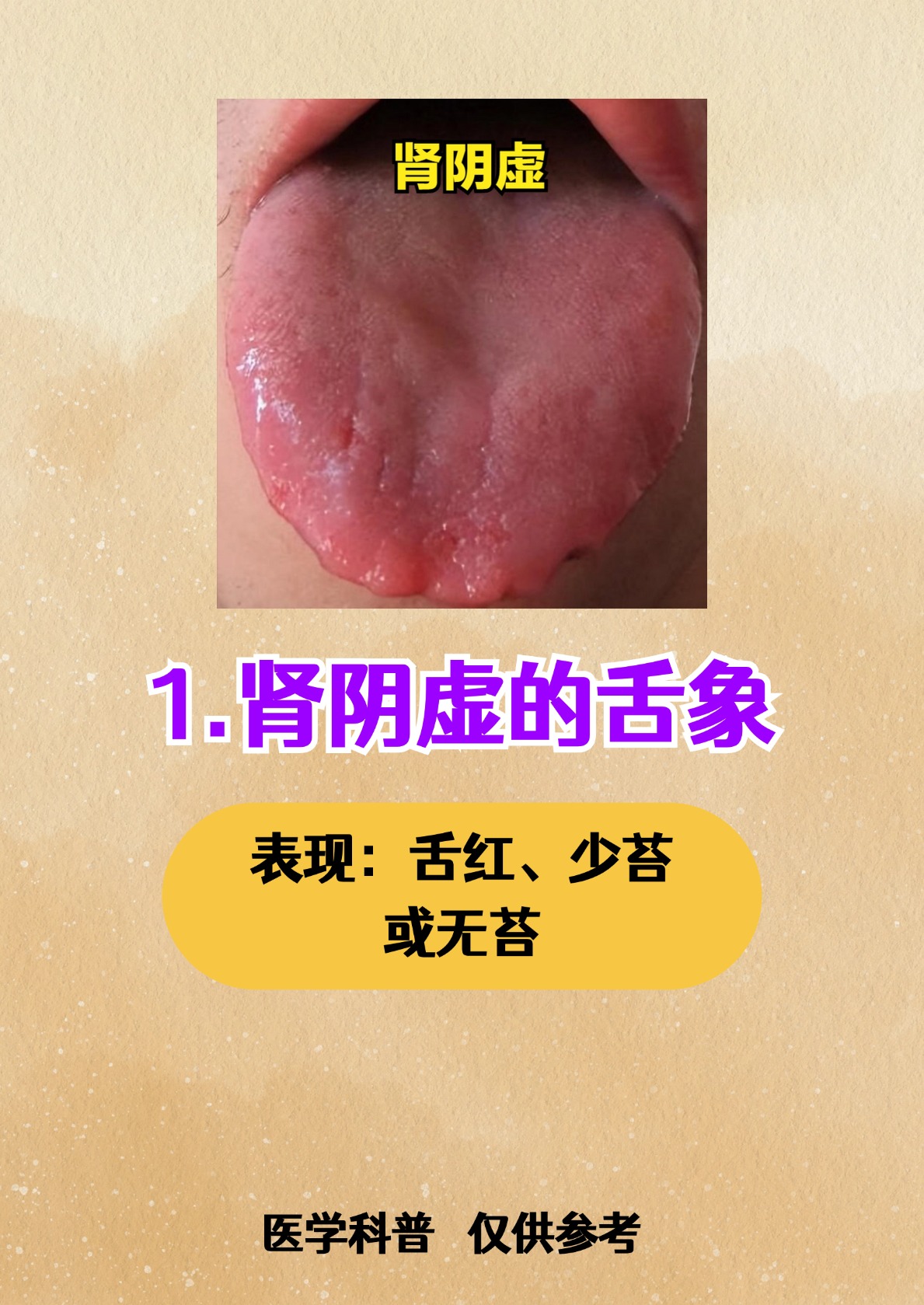 肾阴虚的舌(肾阴虚的舌像)