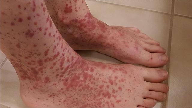 血小板低的朋友,多观察皮肤,没出现这3种情况,就不用太担心!