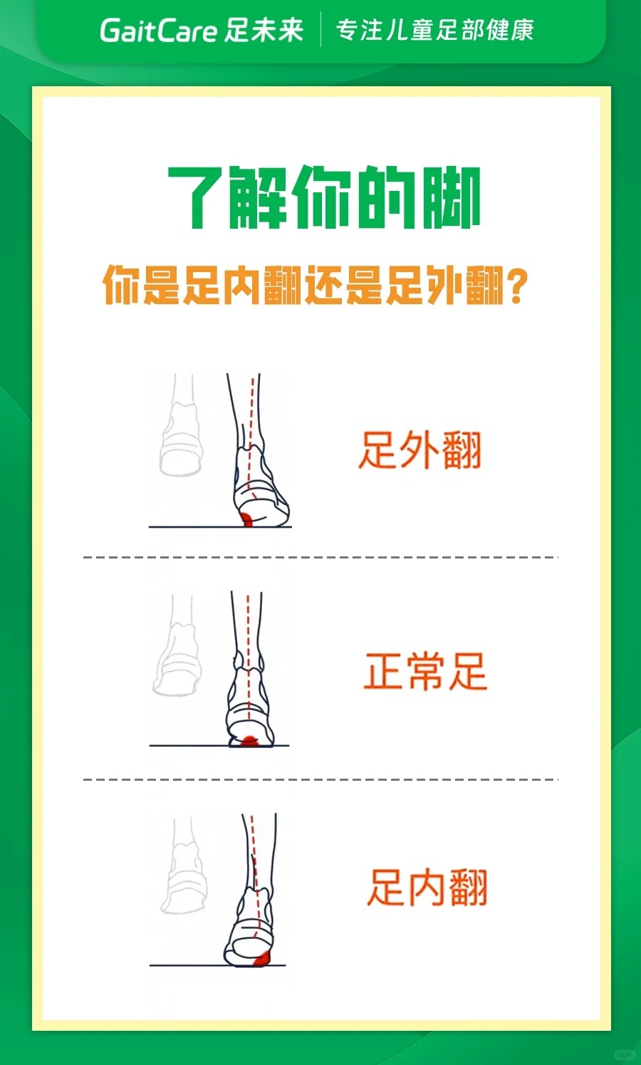 1秒识别孩子足内翻还是足外翻?