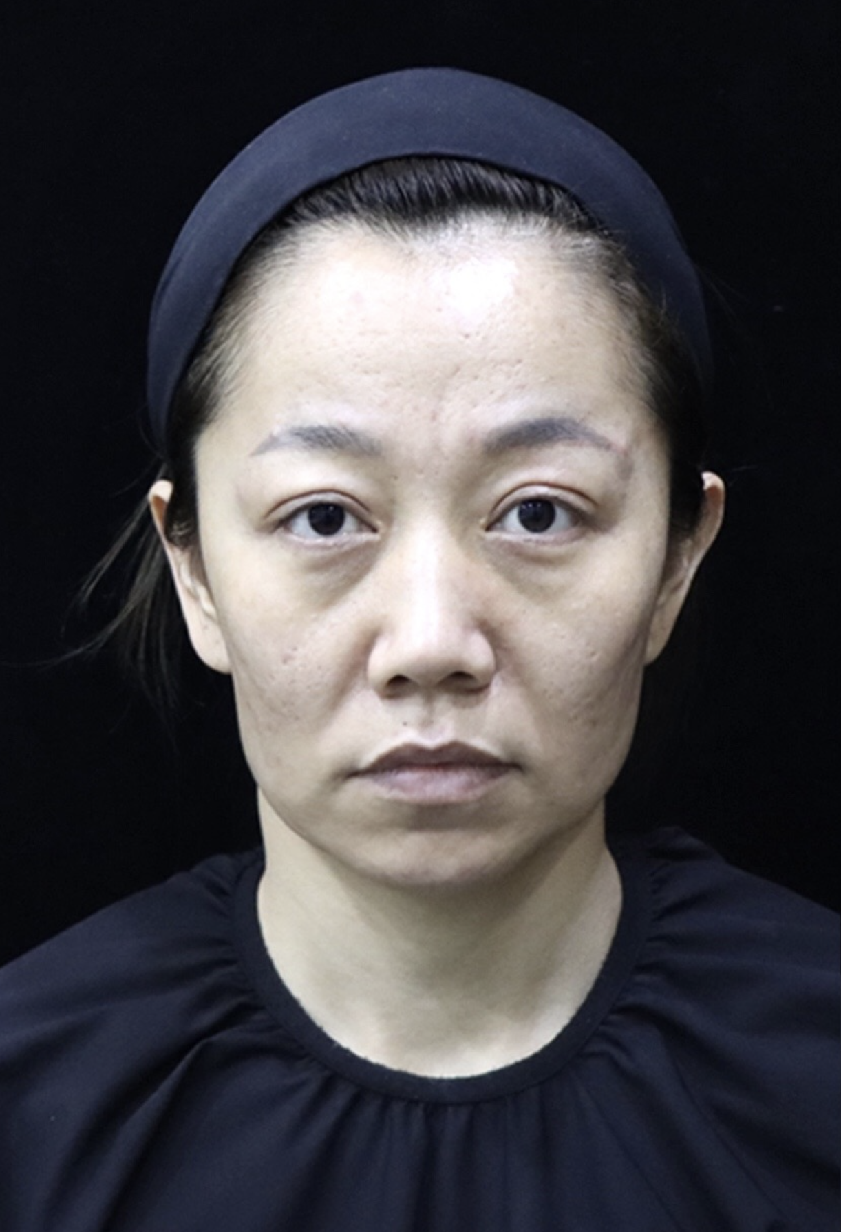 图片面部松弛严重过度打胶原连凹凸不平额头饱满可是有坑坑洼洼不平整