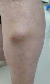 小腿迎面骨有肿块按压就疼的原因