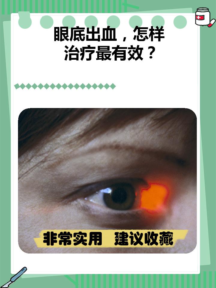 眼底出血的最佳治疗方法是怎样的?  面对眼底出血,别担心!