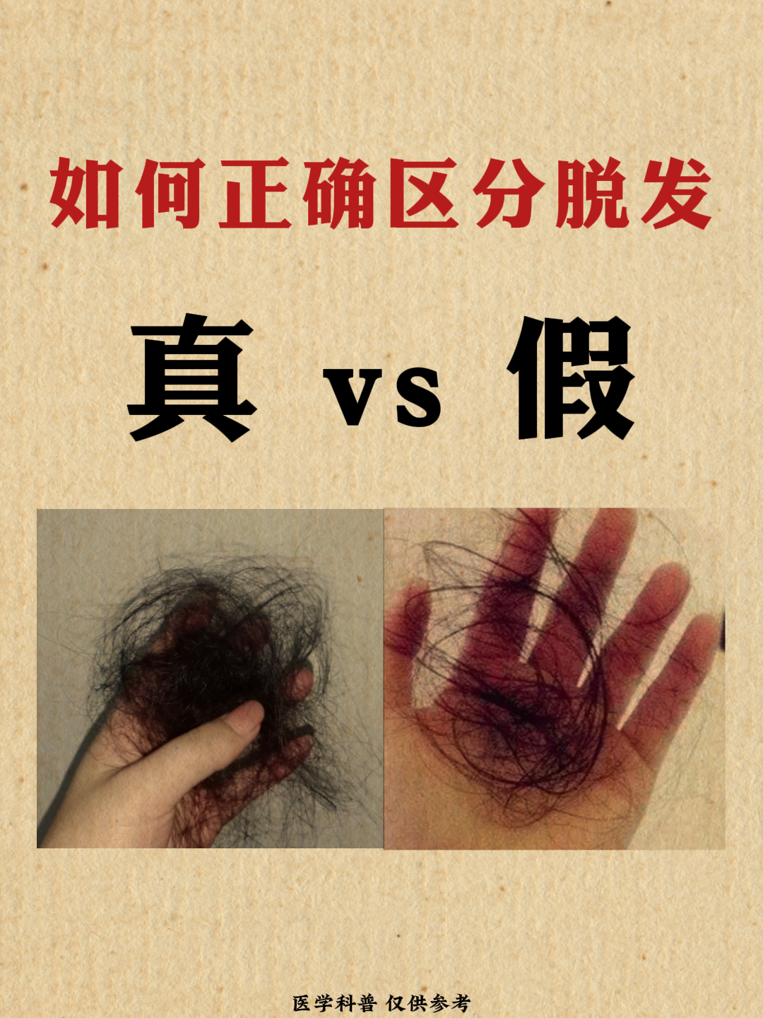 你是真脱发,还是假脱发  #脱发# #防脱发# #脂溢性脱发# #脂溢性脱发