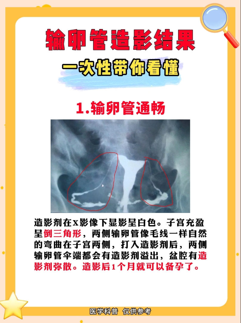 帮助医生判断子官是否存在畸形,宫腔内有无占位左侧输卵管远端迂曲